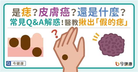 痣上面長痘痘|是痣or皮膚癌？醫「1張圖秒對照」 長這2部位最危險